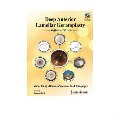 Deep Anterior Lamellar Keratoplasty Different Strokes By Vishal Jhanji