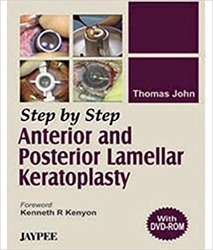 Step By Step Anterior and Posterior Lamellar Keratoplasty (with DVD)