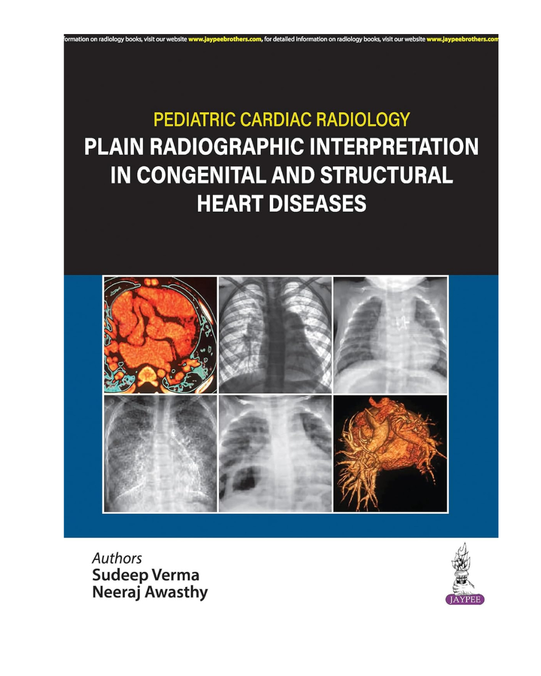 Pediatric Cardiac Radiology Plain Radiographic Interpretation in Congenital and Structural Heart Diseases 1/e 2024 by Sudeep Verma