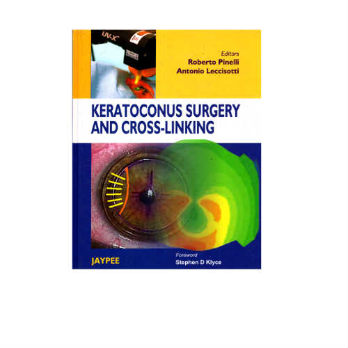 Keratoconus Surgery And Cross-Linking